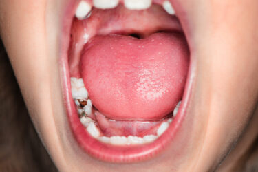 子どもの虫歯を予防するためには？