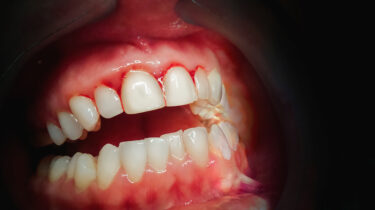 歯周病とは③～歯周病ってどんな治療をするの？～