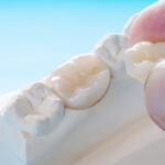 仙台市泉区の歯医者　明石台歯科医院　保険の白い歯と自費の白い歯