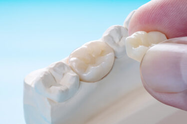 保険の白い歯と自費の白い歯で何が違うのか？（後編）