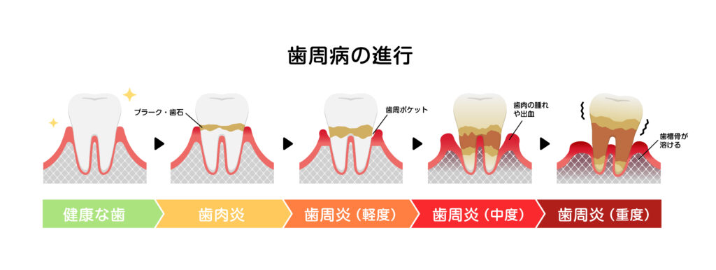仙台市泉区の歯医者　歯周病の進行段階　明石台歯科医院