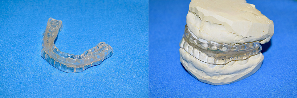 明石台　歯医者　口腔内装置